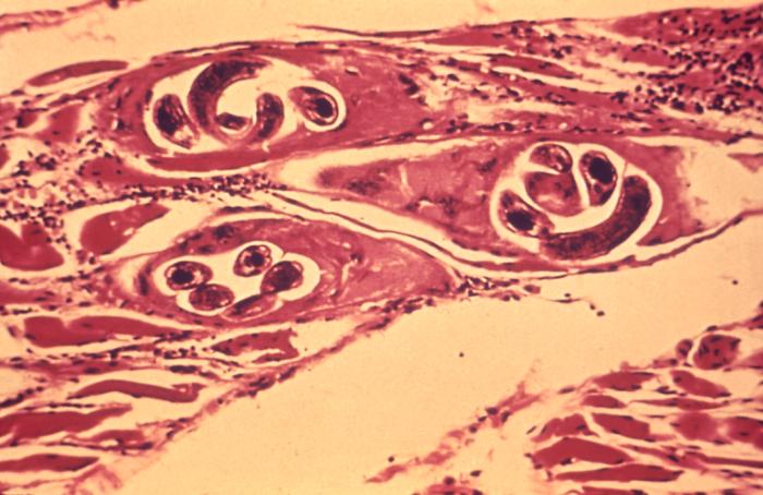Trichineliozė Nuotrauka Nr. 1