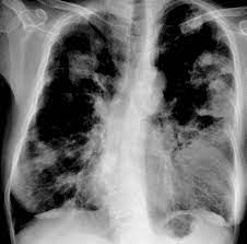 Plaučių aspergiliozė Nuotrauka Nr. 2
