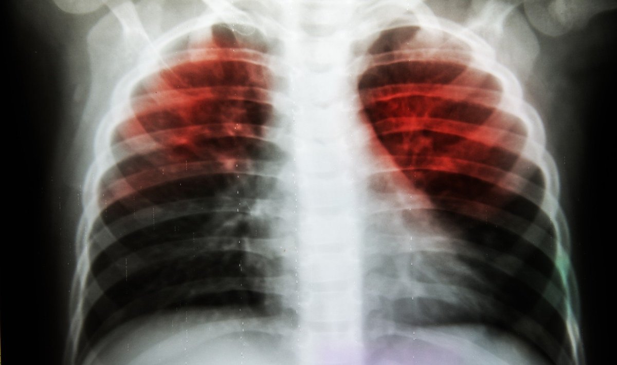 Plaučių tuberkuliozė Nuotrauka Nr. 1