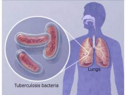 Kvėpavimo organų tuberkuliozė Nuotrauka Nr. 1