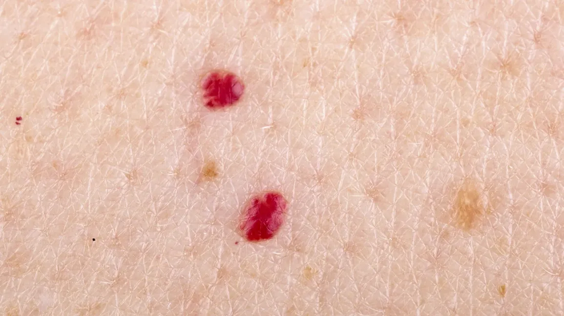 Vyšninės angiomos: ar šie maži raudoni taškeliai - apgamai ant odos yra pavojingi? Ką reikia apie juos žinoti?
