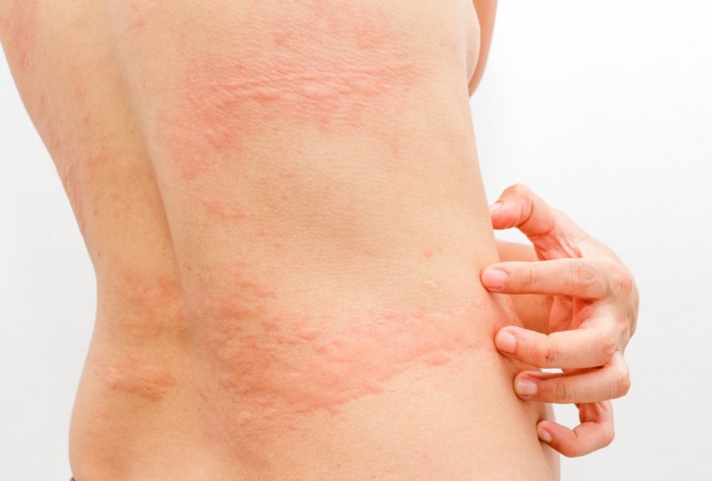 Alergija yra organizmo pernelyg jautri reakcija į tam tikrus medžiagų tipus, vadinamus alergenais