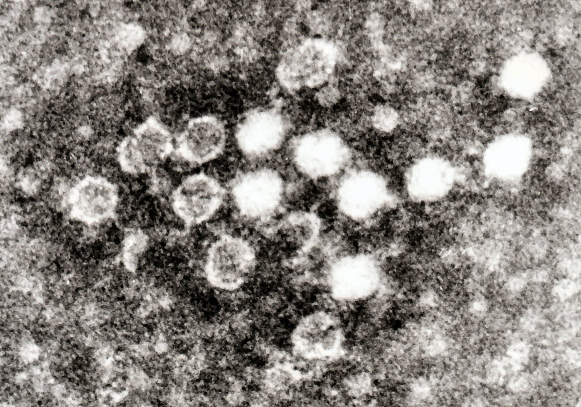 Parvovirusas B19